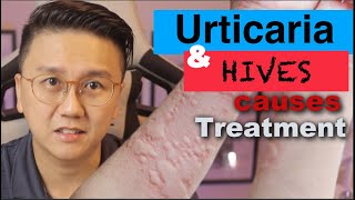 URTICARIA amp HIVES  Causes and Treatment of Itchy Skin Rash [upl. by Cathy279]