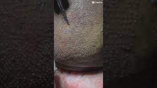 Hair transplant 5000 grafts 5 nepal hairtransplant shorts youtubeshorts satisfying [upl. by Akimak]