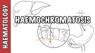 Haemochromatosis Iron Overload  iron physiology causes and pathophysiology [upl. by Dorey291]