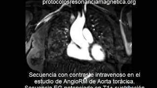 AORTA CIV EG SUSTRACCION [upl. by Nitsirc]