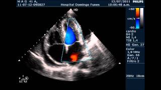 Pericarditis AgudaTaponamiento Cardiaco Dr Pedro Guillermo Bustos 12 Julio 2011 [upl. by Ylurt356]