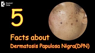 5 Facts about Dermatosis Papulosa Nigra  What are DPN’s  Dr Divya SharmaDoctors Circle [upl. by Drofliw107]