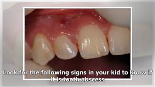 Abscessed Tooth In Child  Causes Symptoms And Treatment [upl. by Lattie]