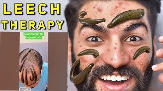 leach therapy documentaryqanoon e health Qanoon Mufrad Azahakeem ayurvedaleech treatment [upl. by Golter451]