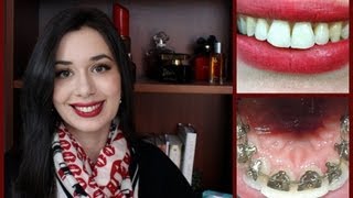 • Incognito Lingual Braces Treatment Final Reveal and Review [upl. by Urbai]