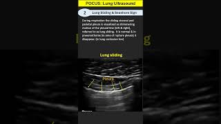 POCUS 2 Lung Ultrasound Lung Sliding amp Seashore Sign [upl. by Witte]