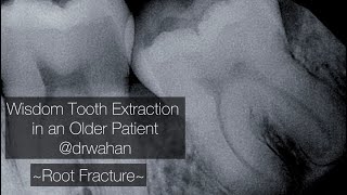 Root Fracture and Removal with Wisdom Tooth Extraction drwahan [upl. by Ynad861]