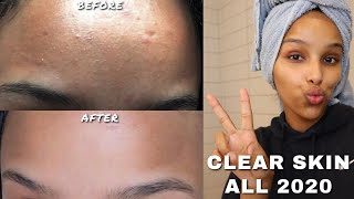 HOW I CLEARED TINY BUMPS AND TEXTURE ON MY FACE  GET SMOOTH SKIN [upl. by Klute]