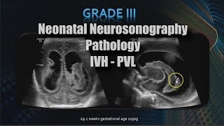 Neonatal Neurosonography  Pathology  IVH  PVL [upl. by Lamrej363]