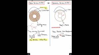 New Vessels on Iris NVI vs Normal Vessels Shorts [upl. by Neyugn975]