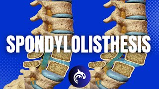 Understanding Spondylolisthesis amp Treatments 3D Animation [upl. by Yhtac9]