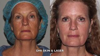 Derma Health Laser Skin Resurfacing  Active FX Patient Testimony [upl. by Cromwell]