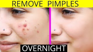 How To Remove Pimples Overnight  Acne Treatment  Anaysa [upl. by Sundberg453]