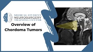 Overview of Chordoma Tumors [upl. by Porty]