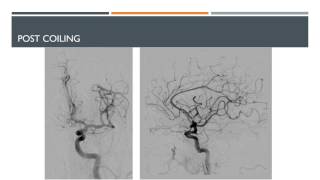 Coiling of ruptured Anterior Communicating Artery Aneurysm [upl. by Torray606]