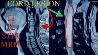 Cervical Spinal cord lesion on MRI  Syringomyelia SpinettaOficialdrrajneeshkant [upl. by Abdul]