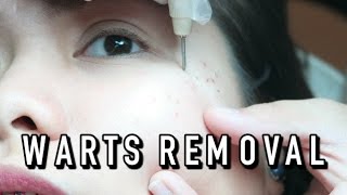 WARTS REMOVAL LETS FACE IT  VLOG [upl. by Amalburga240]