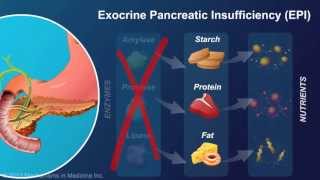 Exocrine Pancreatic Insufficiency [upl. by Hertz952]