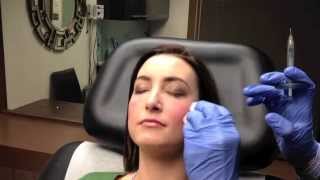 Juvederm VOLUMA Instant Cheek Augmentation in Chevy Chase MD  Dr Naderi [upl. by Cecilio]