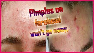 PimplesAcne on Forehead Causes amp Treatment [upl. by Rhine23]