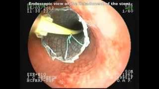 Positioning without fluorscopic esophageal SEMS [upl. by Alebasi]