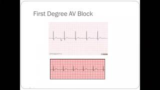 15 Arrhythmias AV Blocks Atrial Fibrillation  Atrial Flutter Multifocal Tachycardia UHS MBBS [upl. by Cirenoj]