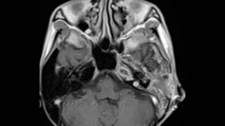 Petrous Apex Abscess [upl. by Demy206]