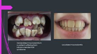 All you need to know about macrodontiaBig teeth by DrAmin [upl. by Yecram]