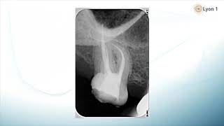 1 Obturation canalaire introduction  Endodontie [upl. by Aleyak574]