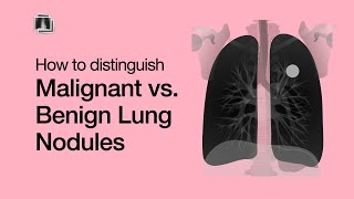 Distinguish Malignant vs Benign Lung Nodules [upl. by Eaj]