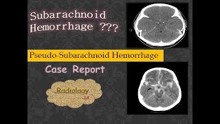 Case Report PseudoSubarachnoid Hemorrhage VS Subarachnoid Hemorrhage CT Brain  Cerebral Edema [upl. by Oniram]