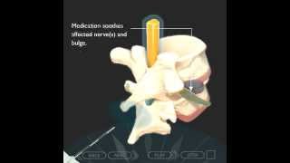 Epidural steroid Injection Translaminar Approachmov [upl. by Neilla]