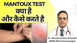 Mantoux Test क्या है और कैसे करते है  Mantoux tuberculin skin test TST TB Test  Diagnosis of TB [upl. by Emmeline]