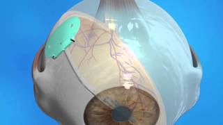 Glaucoma Drainage Implant [upl. by Jakoba]