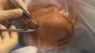 Epidermoid Cyst Removal [upl. by Negiam]