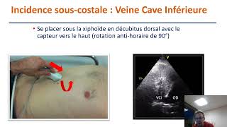 Incidences standards en échocardiographie transthoracique [upl. by Asnerek177]