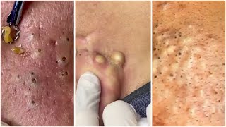 Ultimate Pimple Popping Compilation  Satisfying and Relaxing [upl. by Getraer445]