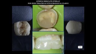 LITHIUM DISILICATE OVERLAY FOR ENDO TREATED MOLAR WITH SUBGINGIVAL CARIES [upl. by Brice823]