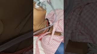 pneumonia kafi serious nursing doctor shortsvideo yourubeshorts doctorlife medico [upl. by Johannes]