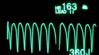 Pulseless Ventricular Tachycardia pVT  Monophasic Defibrillation at 360 Joules [upl. by Arata]