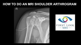 How to do an MRI shoulder arthrogram [upl. by Schuyler132]