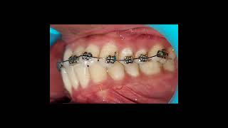 Anterior Crossbite Correction [upl. by Ahsirahc]