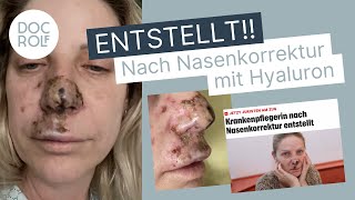 NASENKORREKTUR OHNE OP – Wienerin entstellt 😱 – Dr Rolf Bartsch [upl. by Mullins]