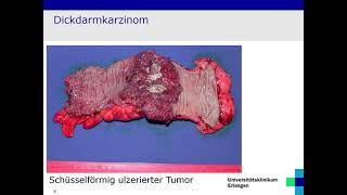 Pathologie und Molekularpathologie des kolorektalen Karzinoms Prof Dr med Arndt Hartmann [upl. by Serg]