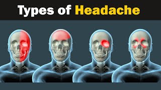 Headache  Types and causes  3d Animation [upl. by Beller]