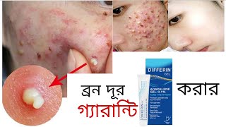 রাতে এই জেল লাগান সকালে ব্রন গায়েব হয়ে যাবে Differin Adapalene Gel  khadija begum  acne treatment [upl. by Egedan34]