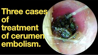 Three cases of treatment of cerumen embolismear wax removal  earcleaning  ASMR  relaxation [upl. by Alicea]