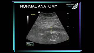 Abdominal aortic aneurysm ultrasound [upl. by Eenet50]