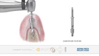 ASTRA TECH Implant System EV  Guided surgery [upl. by Darbee562]