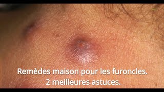 Remèdes Maison Pour Les Furoncles 2 Meilleures Astuces [upl. by Dnalwor]